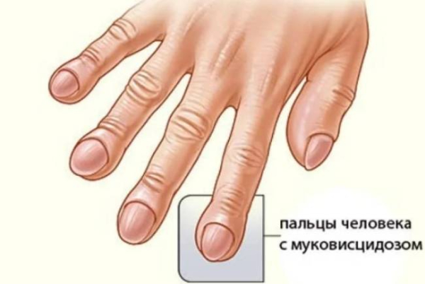 Экзокринная недостаточность поджелудочной железы