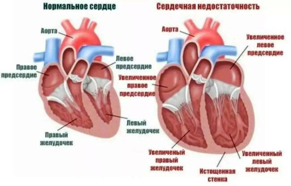 Что такое сердечная недостаточность