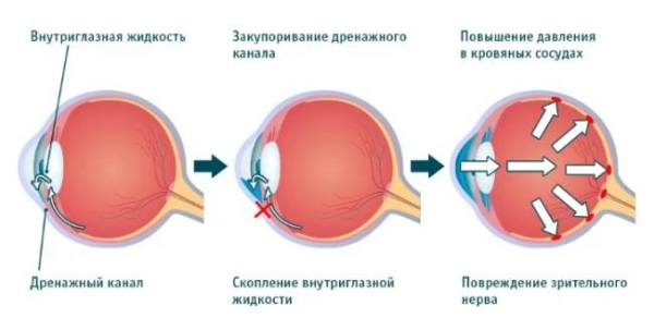 Симптомы глаукомы, которые необходимо знать