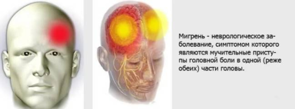 6 триггеров мигрени, которых нужно избегать 6 триггеров мигрени, которых нужно избегать