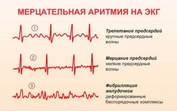 Что заставляет сердце пропускать удары