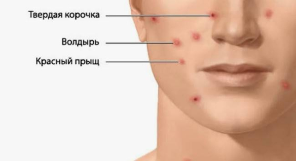 Что такое ветряная оспа Что такое ветряная оспа