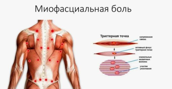 Разница между миофасциальной болью и фибромиалгией