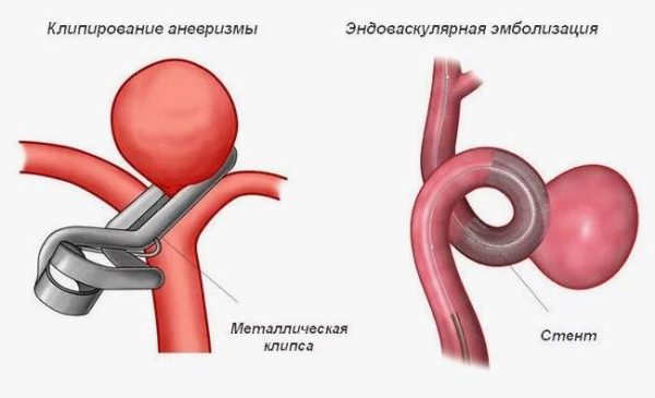 Можно ли предотвратить аневризму головного мозга