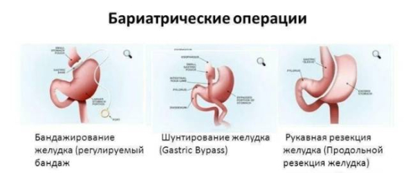 Самые любопытные вопросы о бариатрической хирургии Самые любопытные вопросы о бариатрической хирургии