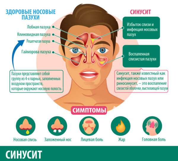 Фронтит: причины, основные симптомы и лечение Фронтит: причины, основные симптомы и лечение