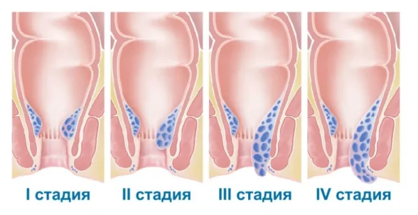 Симптомы и лечение геморроя