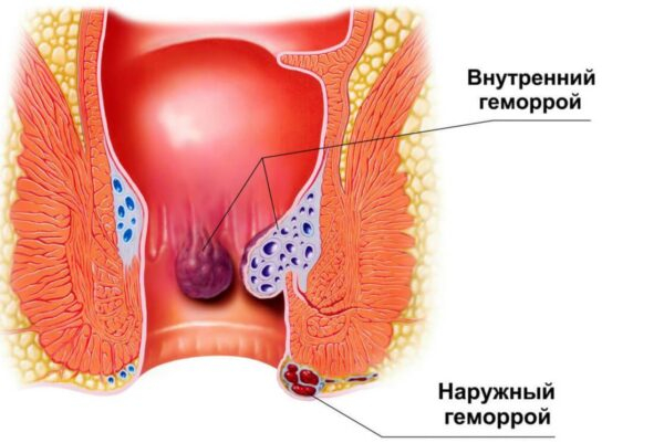 Симптомы и лечение геморроя