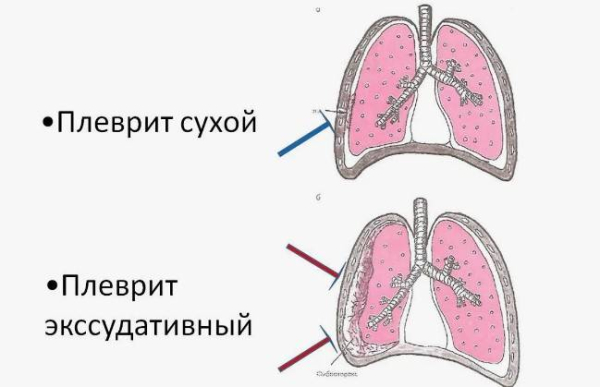Что такое плеврит Что такое плеврит