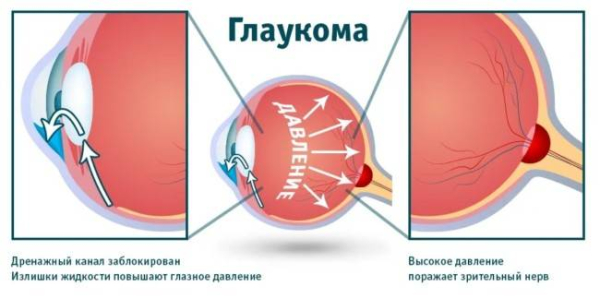 Как диабет влияет на глаза Как диабет влияет на глаза
