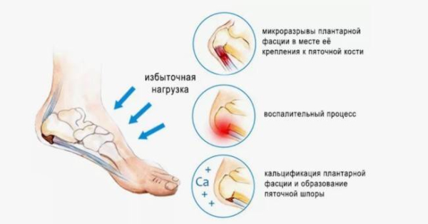 Что такое подошвенный фасциит (боль в пятке)
