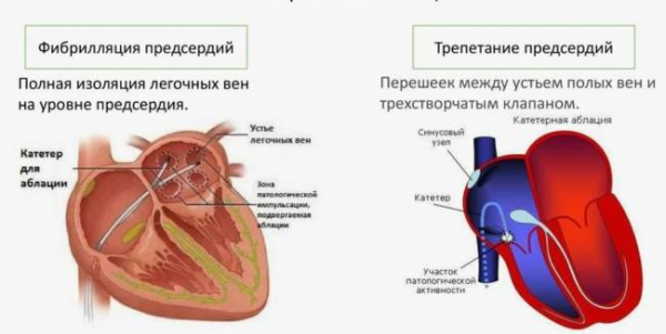 Нерегулярное сердцебиение? Это может быть мерцательная аритмия