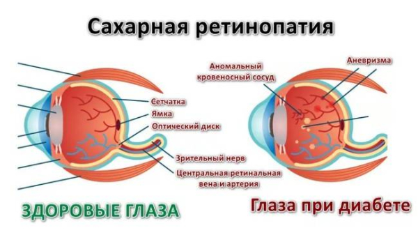 Как диабет влияет на глаза Как диабет влияет на глаза