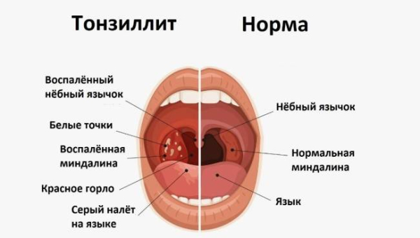 Следует ли использовать антибиотики при ангине