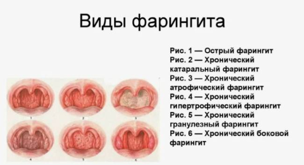 Почему фарингит возвращается