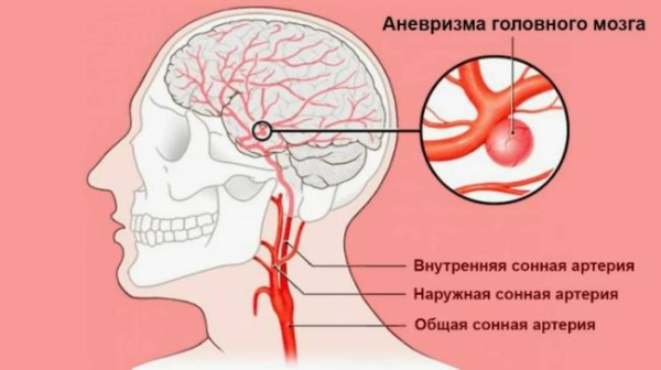 Можно ли предотвратить аневризму головного мозга