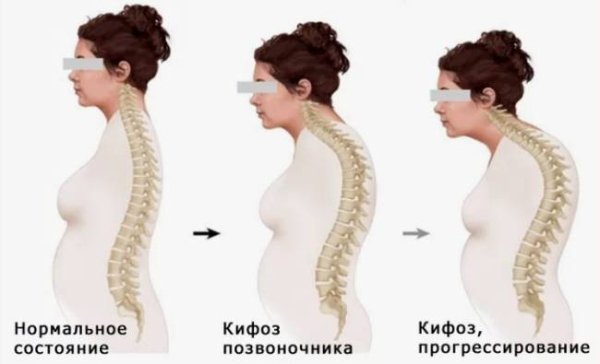 Что такое кифоз Что такое кифоз
