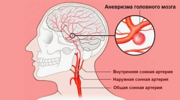 Можно ли вылечить аневризму головного мозга