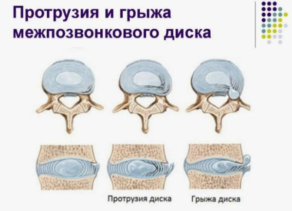 Патофизиология боли в спине