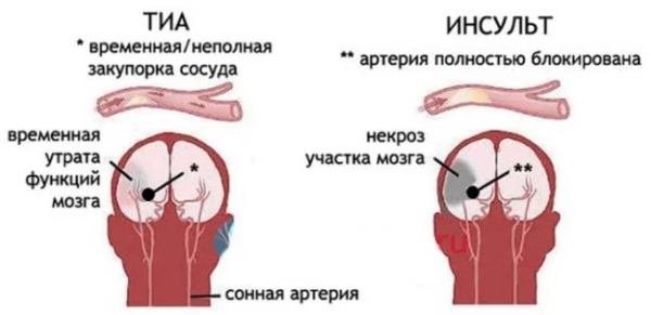 Что такое транзиторные ишемические атаки