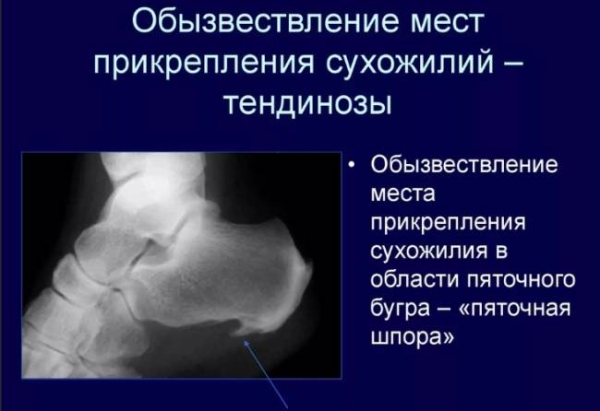 Заболевания костей в результате диализа Заболевания костей в результате диализа
