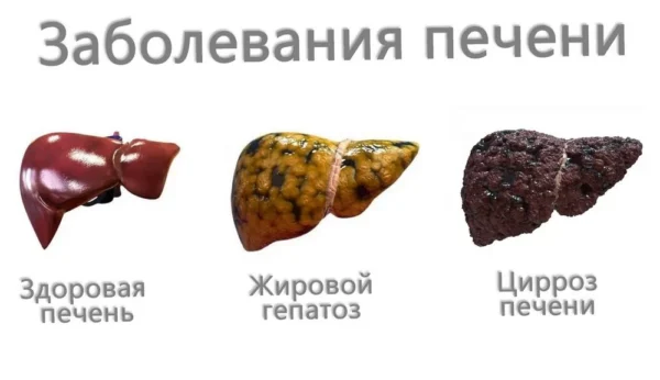 Что такое гепатоз печени: симптомы, причины, лечение Что такое гепатоз печени: симптомы, причины, лечение