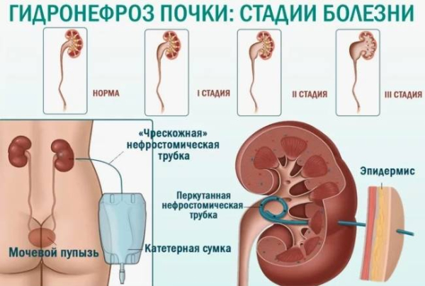 Что такое гидронефроз одной почки