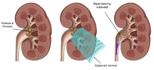 Могут ли камни в почках уйти сами по себе