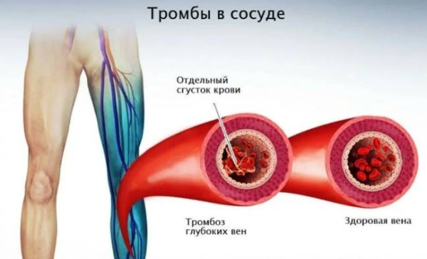 Как и почему образуются тромбы