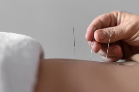 Врач Кареева рассказала, при каких болезнях помогает иглоукалывание