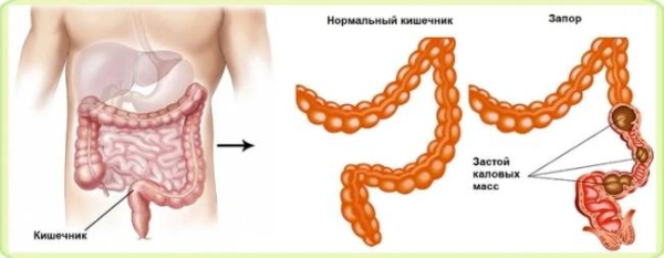 Еще одно натуральное средство от запора