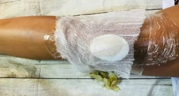 8 естественных методов лечения псориатического артрита