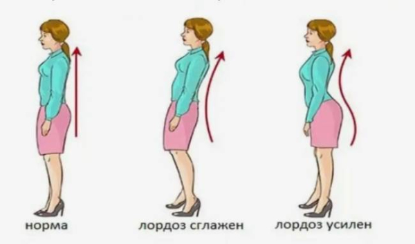 Что такое лордоз