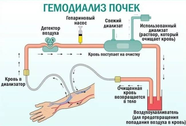 Преимущества диализа