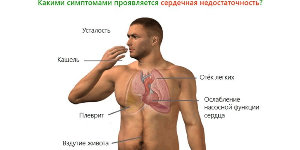 Необычные признаки сердечной недостаточности, на которые важно вовремя обратить внимание Необычные признаки сердечной недостаточности, на которые важно вовремя обратить внимание