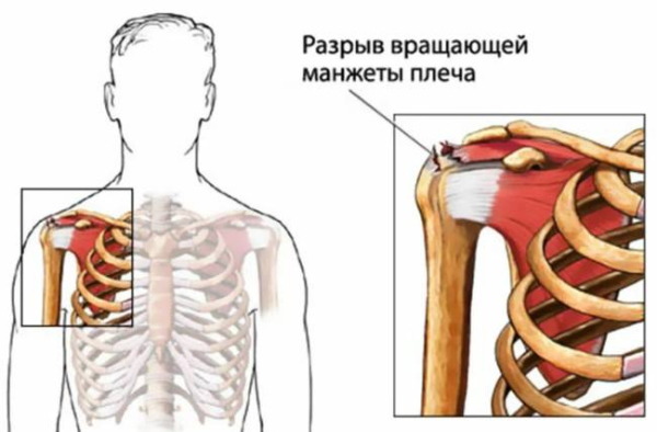 Что такое разрыв вращающей манжеты Что такое разрыв вращающей манжеты