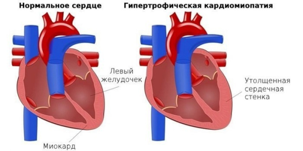 Изменения в сердце после 50 о которых важно знать