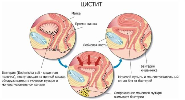10 рекомендаций по профилактике цистита 10 рекомендаций по профилактике цистита