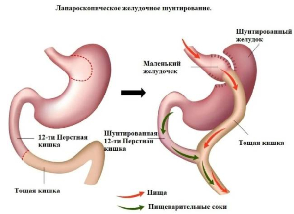 Преимущества и недостатки операции по шунтированию желудка Преимущества и недостатки операции по шунтированию желудка