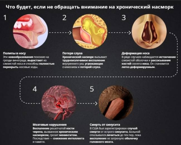 Хронический насморк