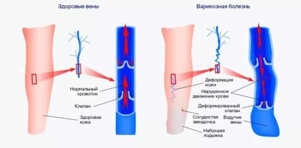 10 рекомендаций по защите от варикозного расширения вен