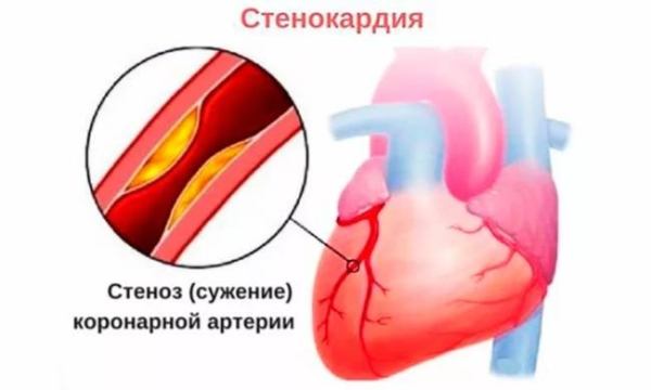 Эффективность и безопасность атенолола при лечении гипертонии и стенокардии