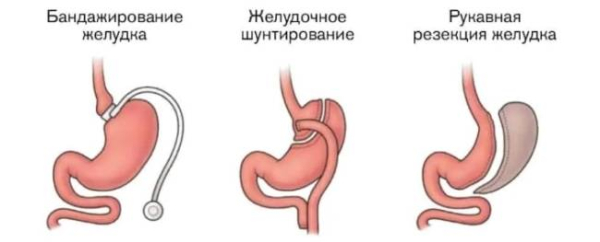 Диета для шунтирования желудка Диета для шунтирования желудка