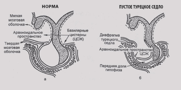 Турецкое седло в головном мозге