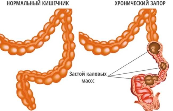 5 признаков низкого уровня калия