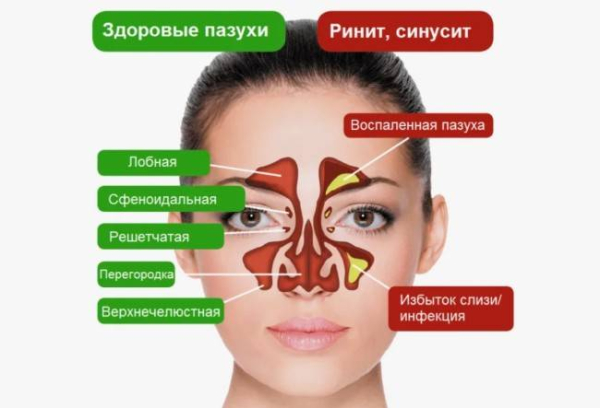 Как отличить насморк от инфекции пазух носа