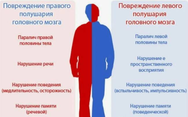 Отличия инсульта правой и левой половины головного мозга
