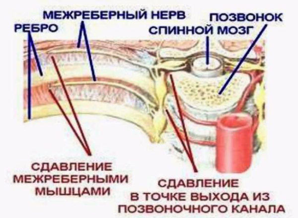 Что такое межреберная невралгия Что такое межреберная невралгия